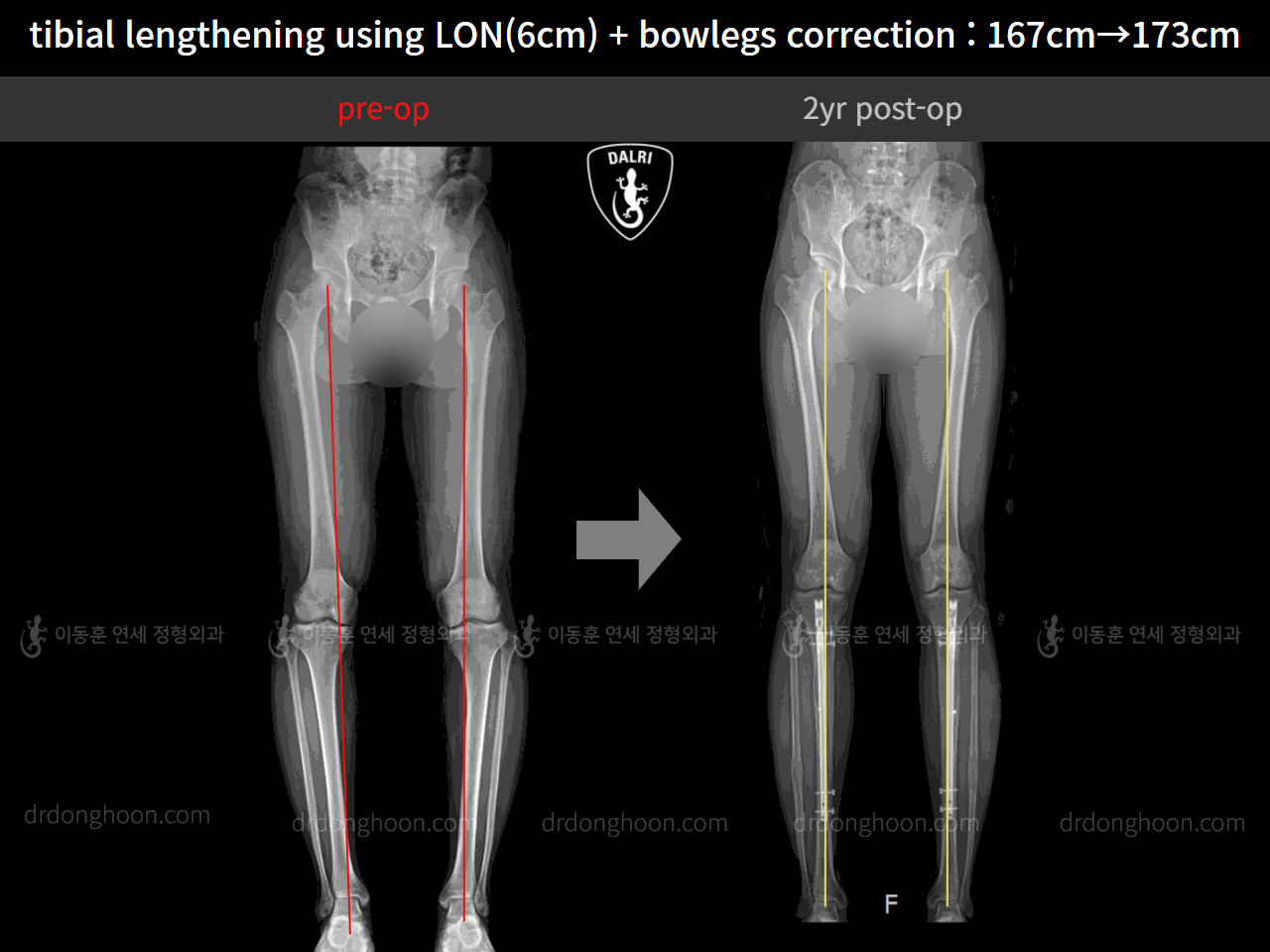 Before and after cll + deformity correction, case 4323147, image 5, Dr. Donghoon institute (DALRI)