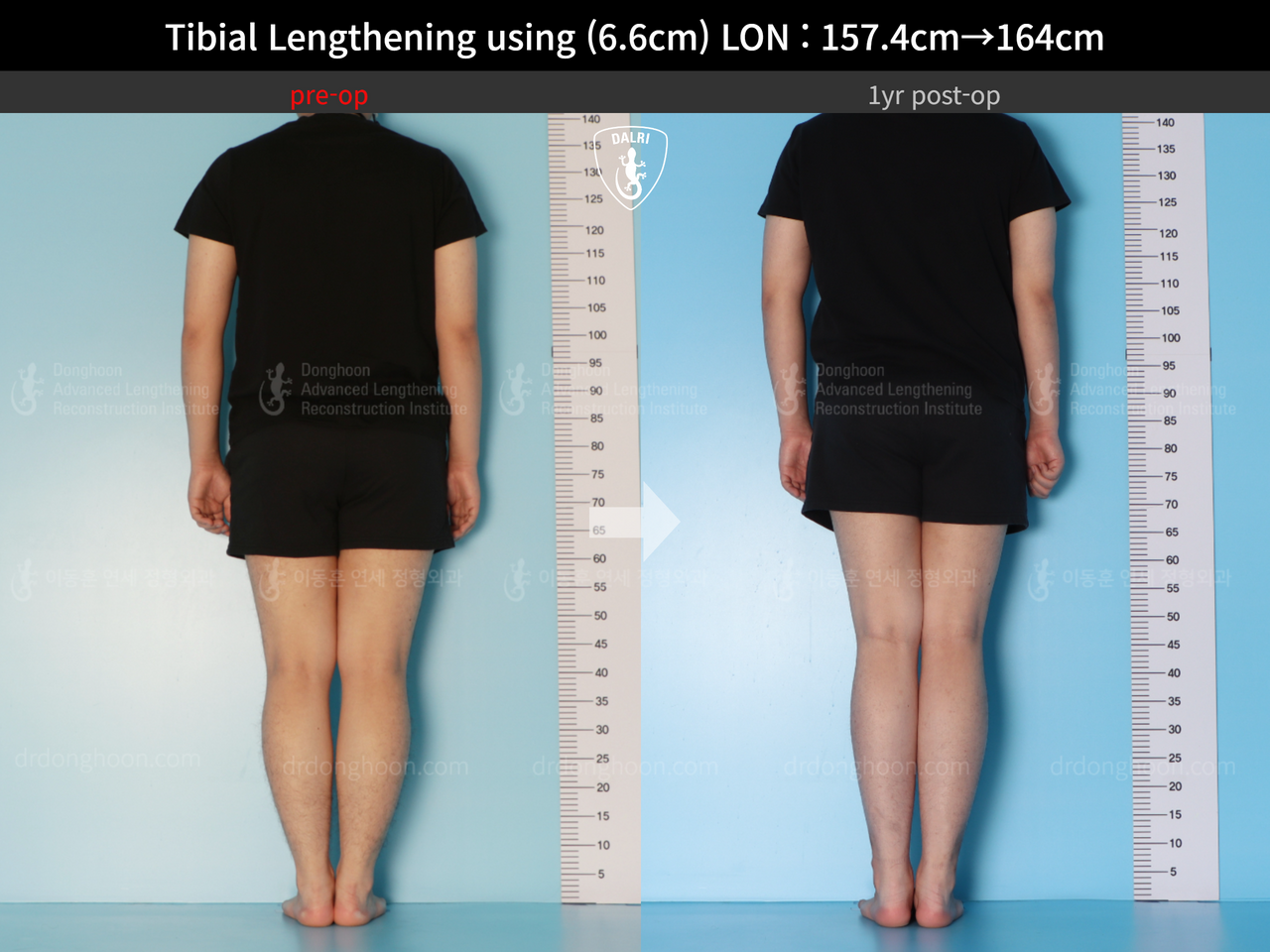 Before and after cll lon, case 13418098, image 2, Dr. Donghoon institute (DALRI)