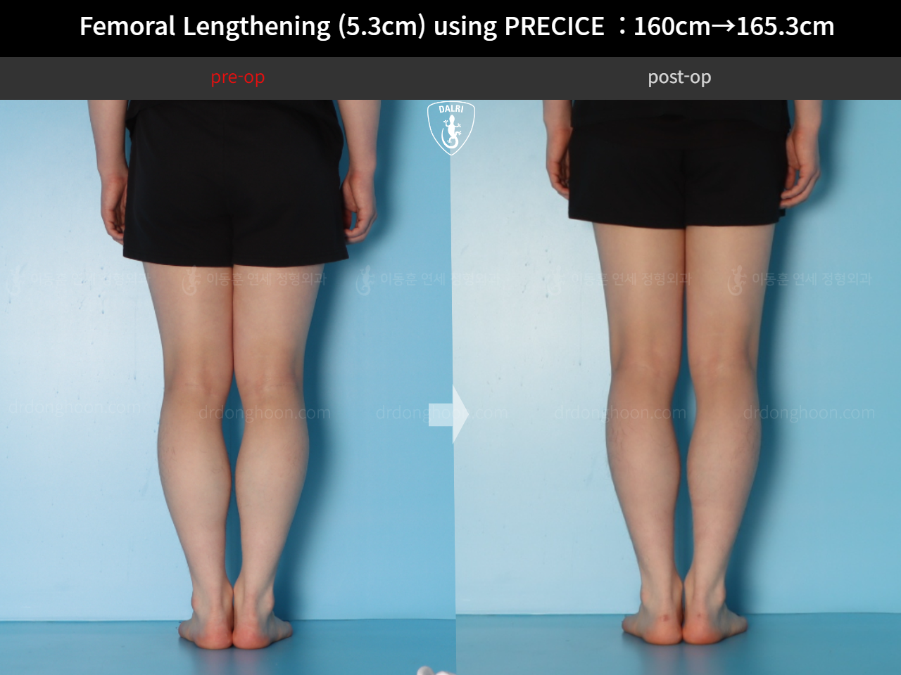 Before and after cll precice, case 18250566, image 8, Dr. Donghoon institute (DALRI)