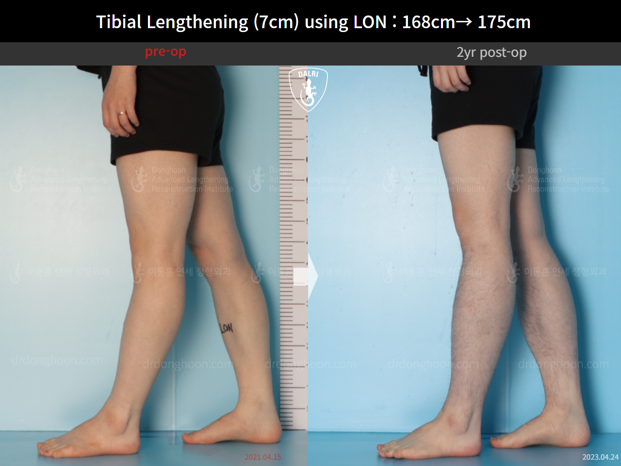 Before and after cll lon, case 14978046, image 9, Dr. Donghoon institute (DALRI)