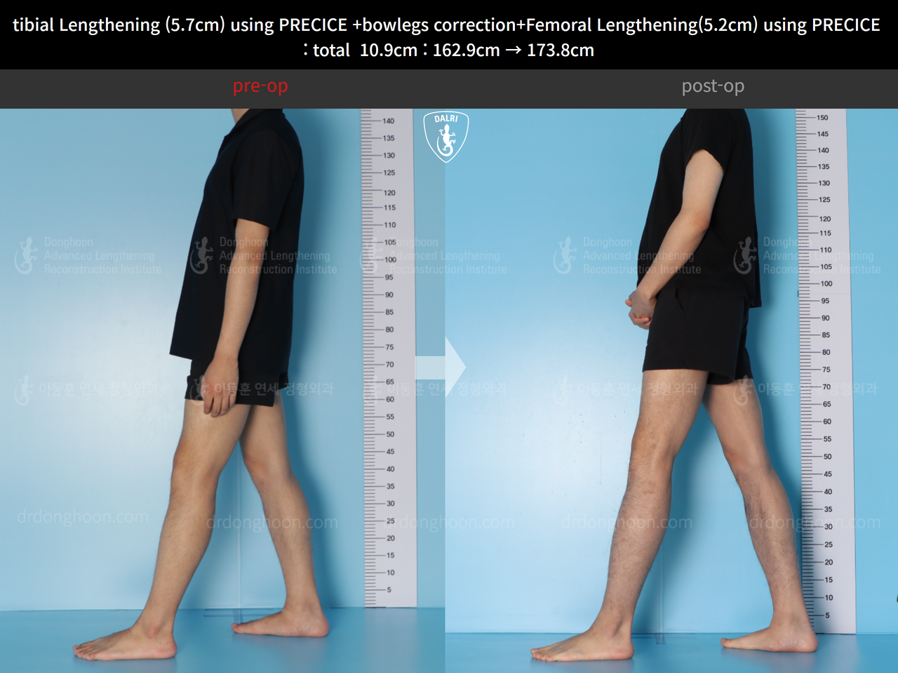 Before and after cll + deformity correction, case 13924912, image 4, Dr. Donghoon institute (DALRI)