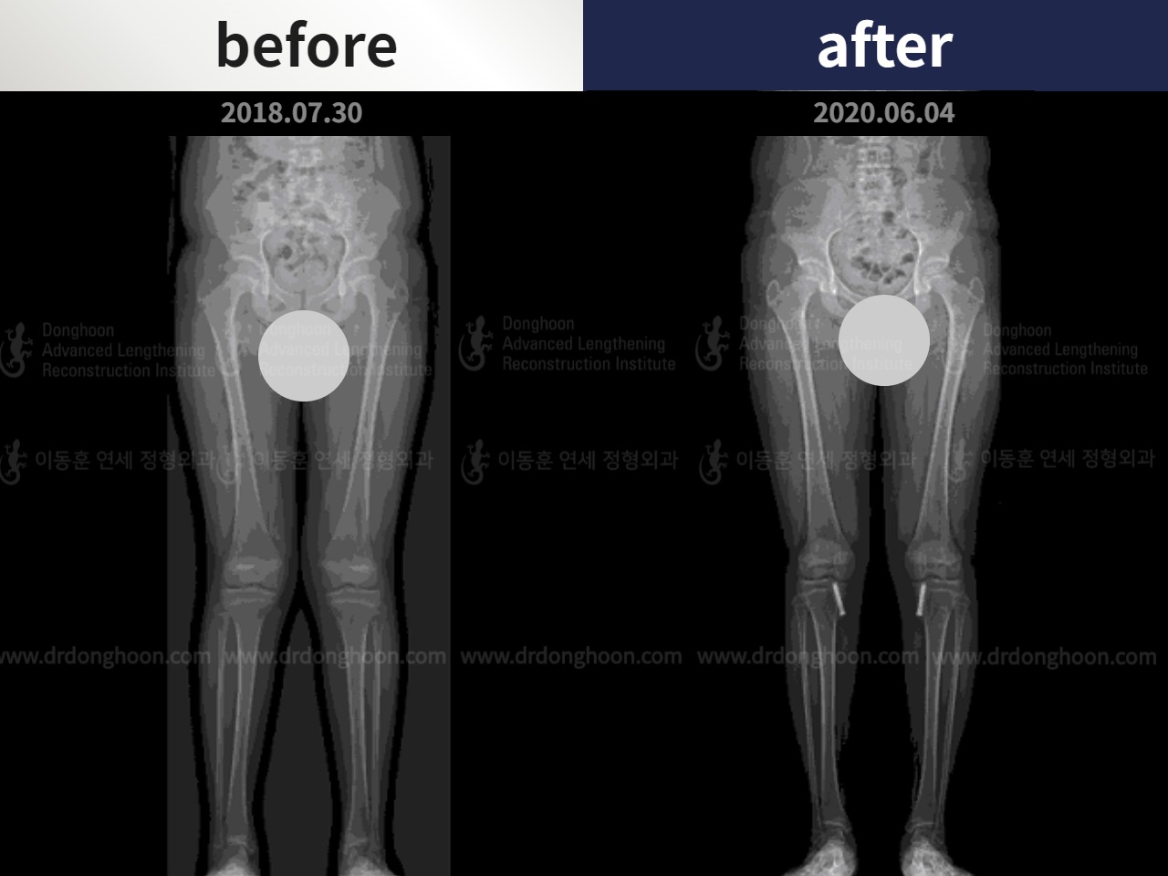 Before and after paediatric & adolescent knock knees, case 4640508, image 3, Dr. Donghoon institute (DALRI)