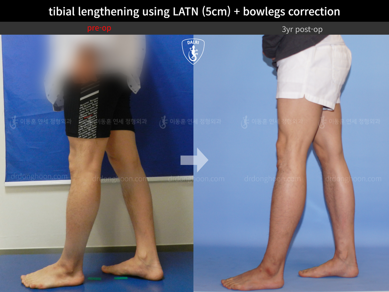 Before and after cll + deformity correction, case 13476494, image 3, Dr. Donghoon institute (DALRI)