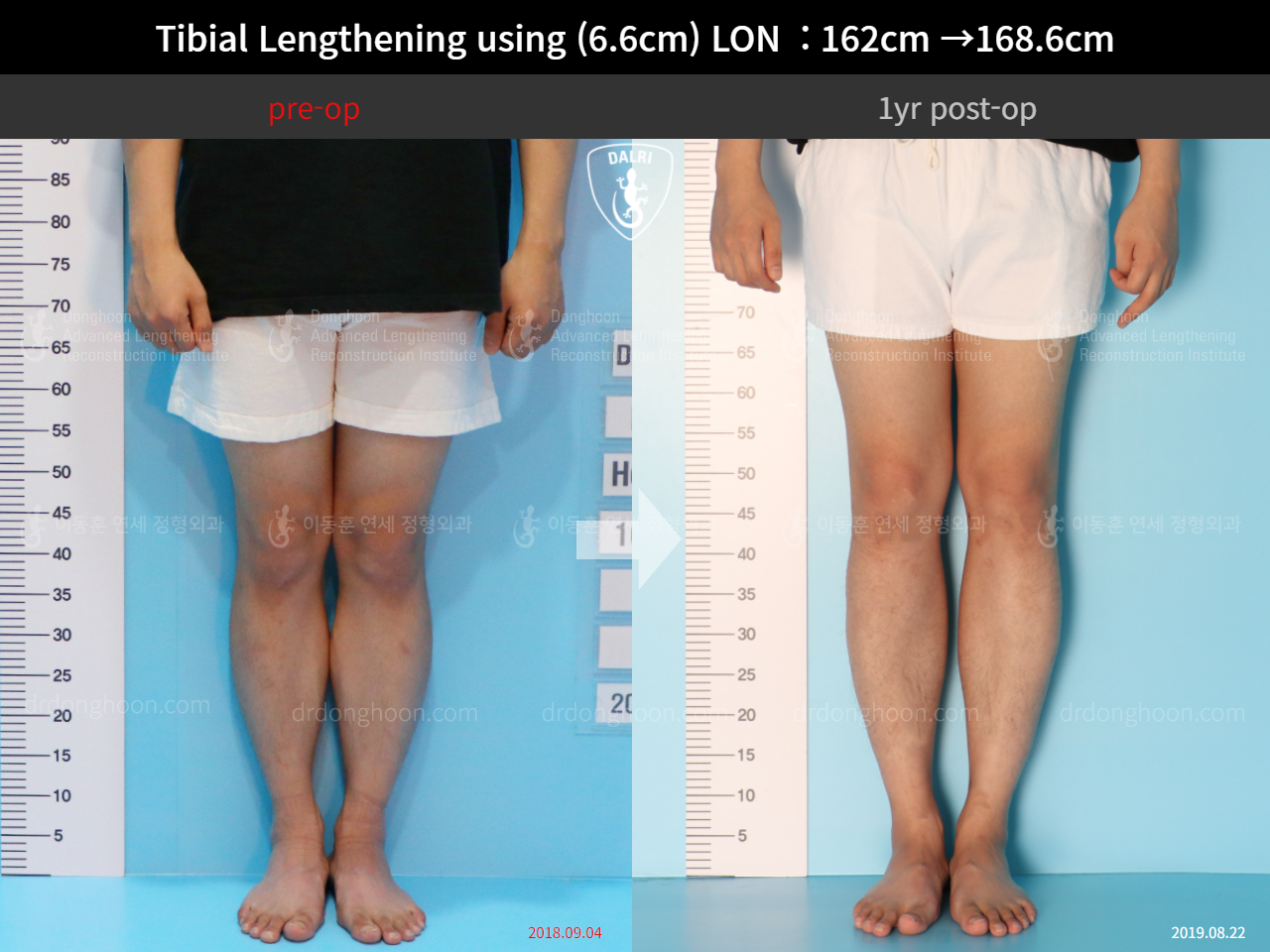 Before and after cll lon, case 4577769, image 5, Dr. Donghoon institute (DALRI)