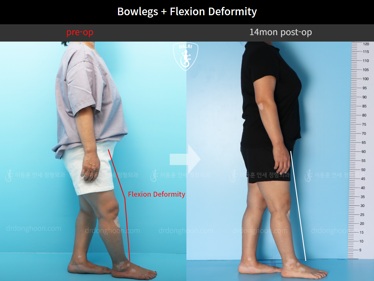 Before and after osteotomy for knee osteoarthritis, case 4586352, image 5, Dr. Donghoon institute (DALRI)