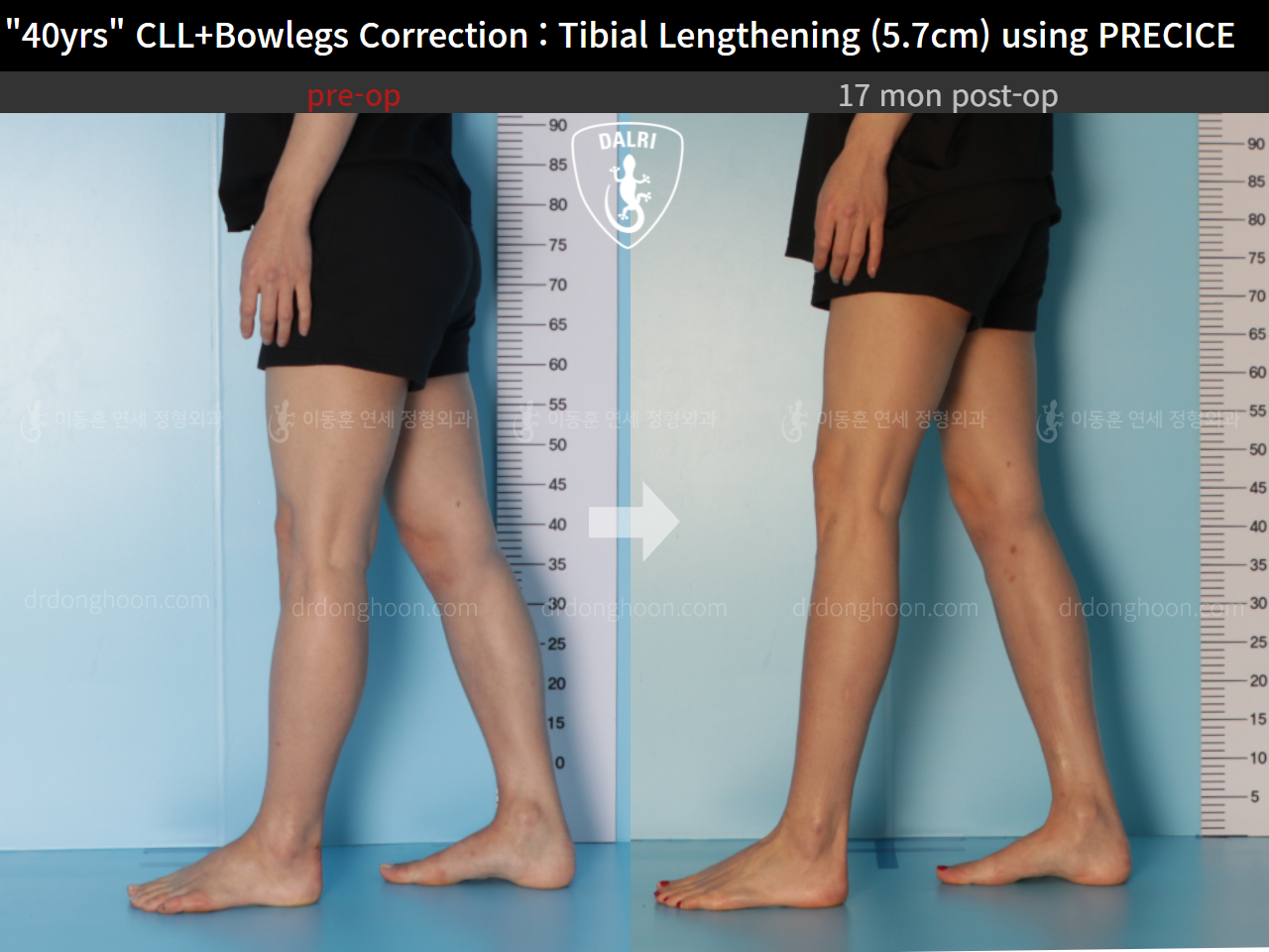 Before and after cll precice, case 9180903, image 8, Dr. Donghoon institute (DALRI)