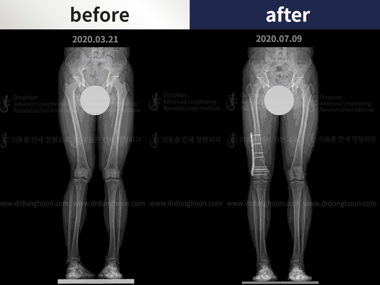 Before and after adult knock knees, case 4640542, image 3, Dr. Donghoon institute (DALRI)