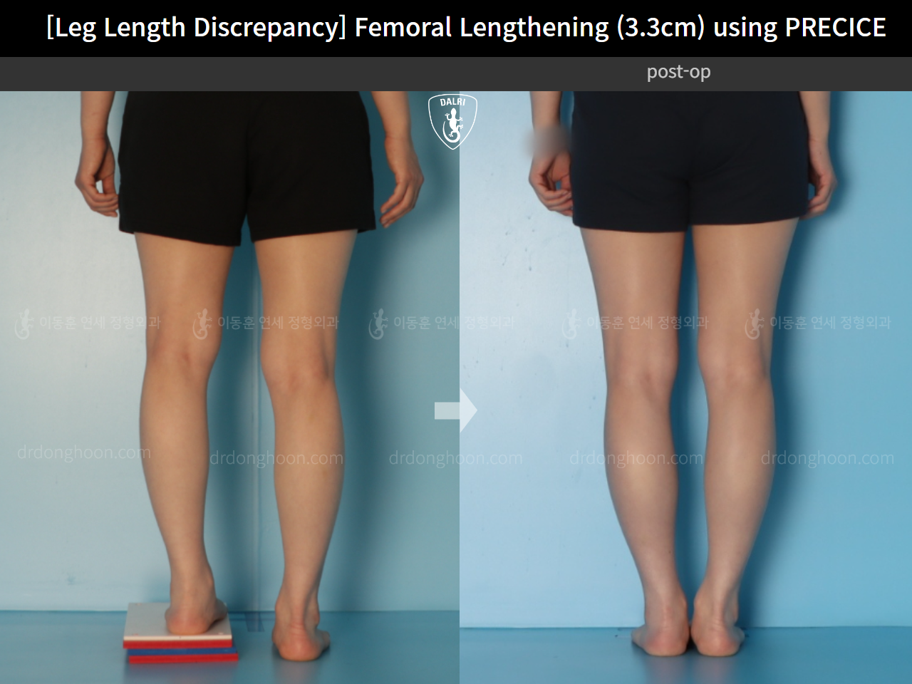 Before and after adult lld, case 22355841, image 6, Dr. Donghoon institute (DALRI)