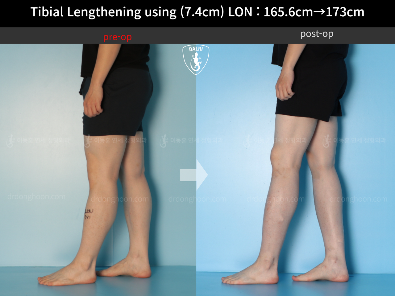 Before and after cll lon, case 13634644, image 7, Dr. Donghoon institute (DALRI)