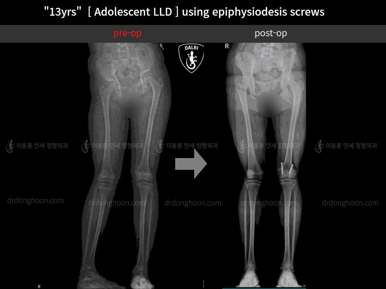 Before and after paediatric & adolescent lld, case 11773378, image 7, Dr. Donghoon institute (DALRI)