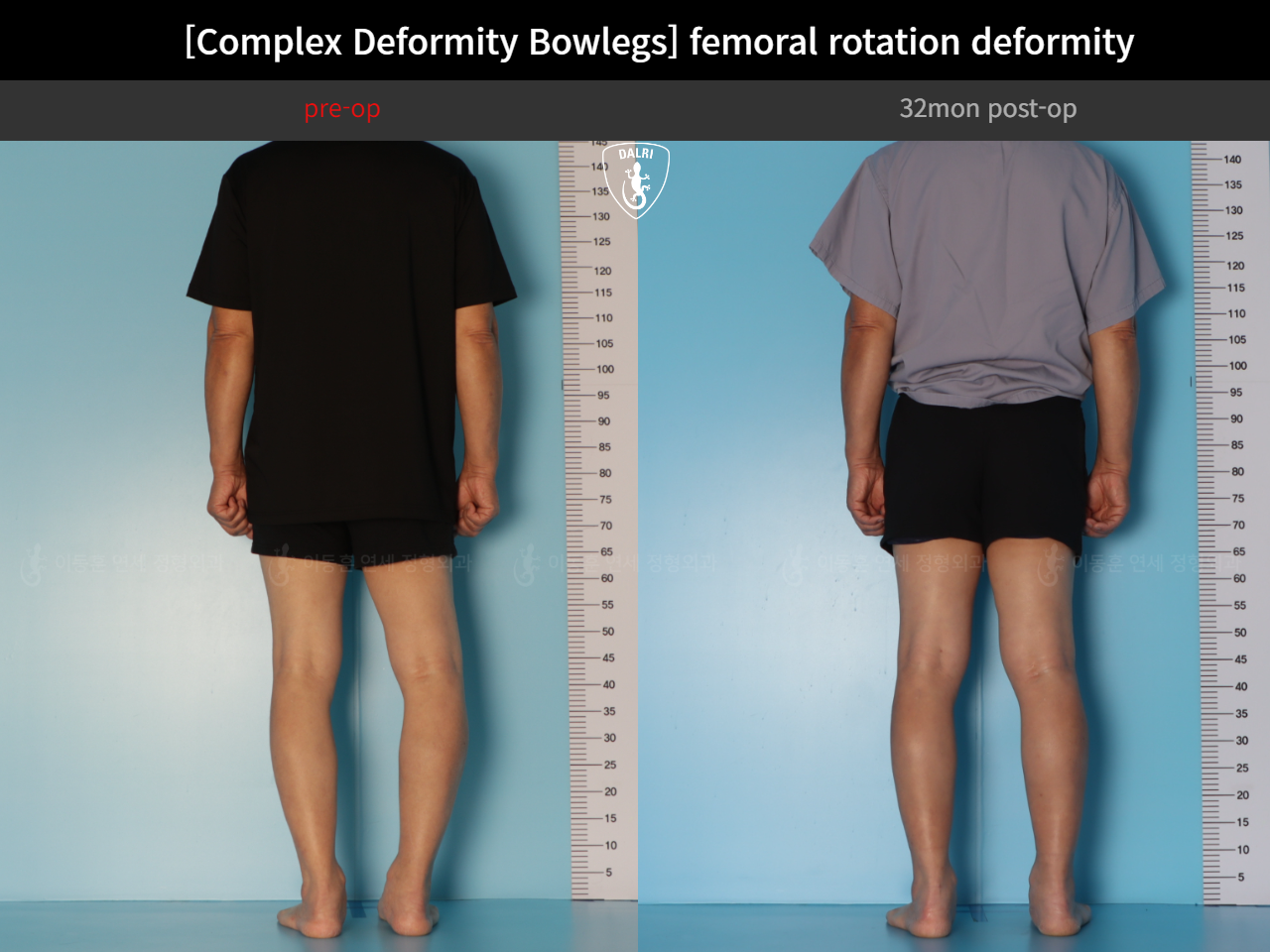 Before and after adult bowlegs, case 35242887, image 7, Dr. Donghoon institute (DALRI)