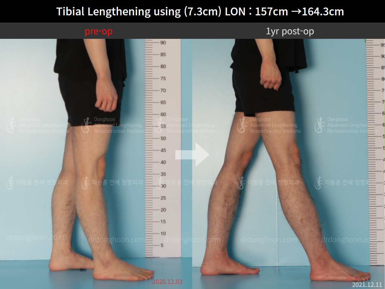 Before and after cll lon, case 9114235, image 7, Dr. Donghoon institute (DALRI)