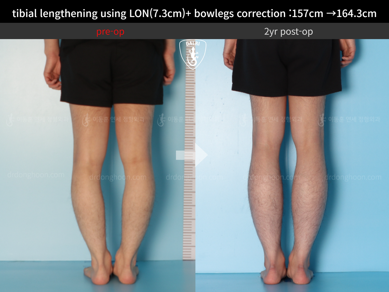 Before and after cll + deformity correction, case 13549500, image 6, Dr. Donghoon institute (DALRI)
