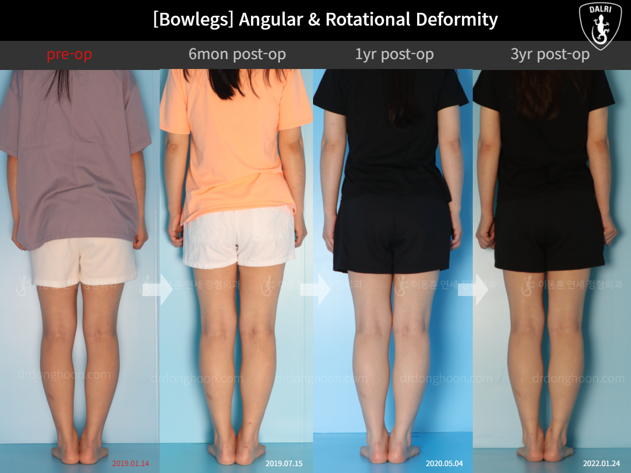 Before and after adult bowlegs, case 9678047, image 2, Dr. Donghoon institute (DALRI)