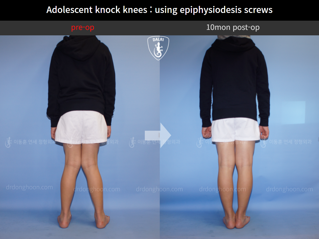 Before and after paediatric & adolescent knock knees, case 4310936, image 2, Dr. Donghoon institute (DALRI)