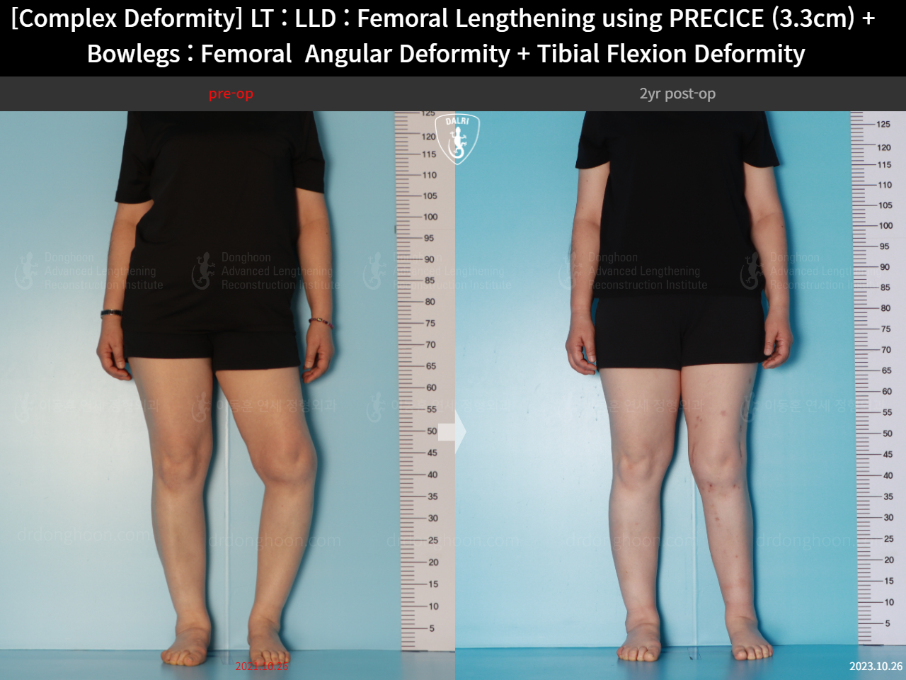 Before and after osteotomy for knee osteoarthritis, case 16786712, image 8, Dr. Donghoon institute (DALRI)
