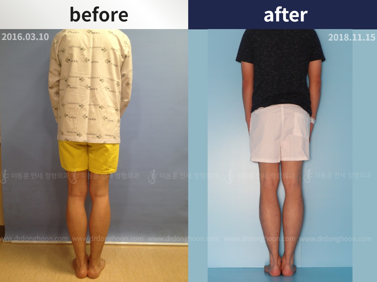 Before and after cll lon, case 4323449, image 3, Dr. Donghoon institute (DALRI)