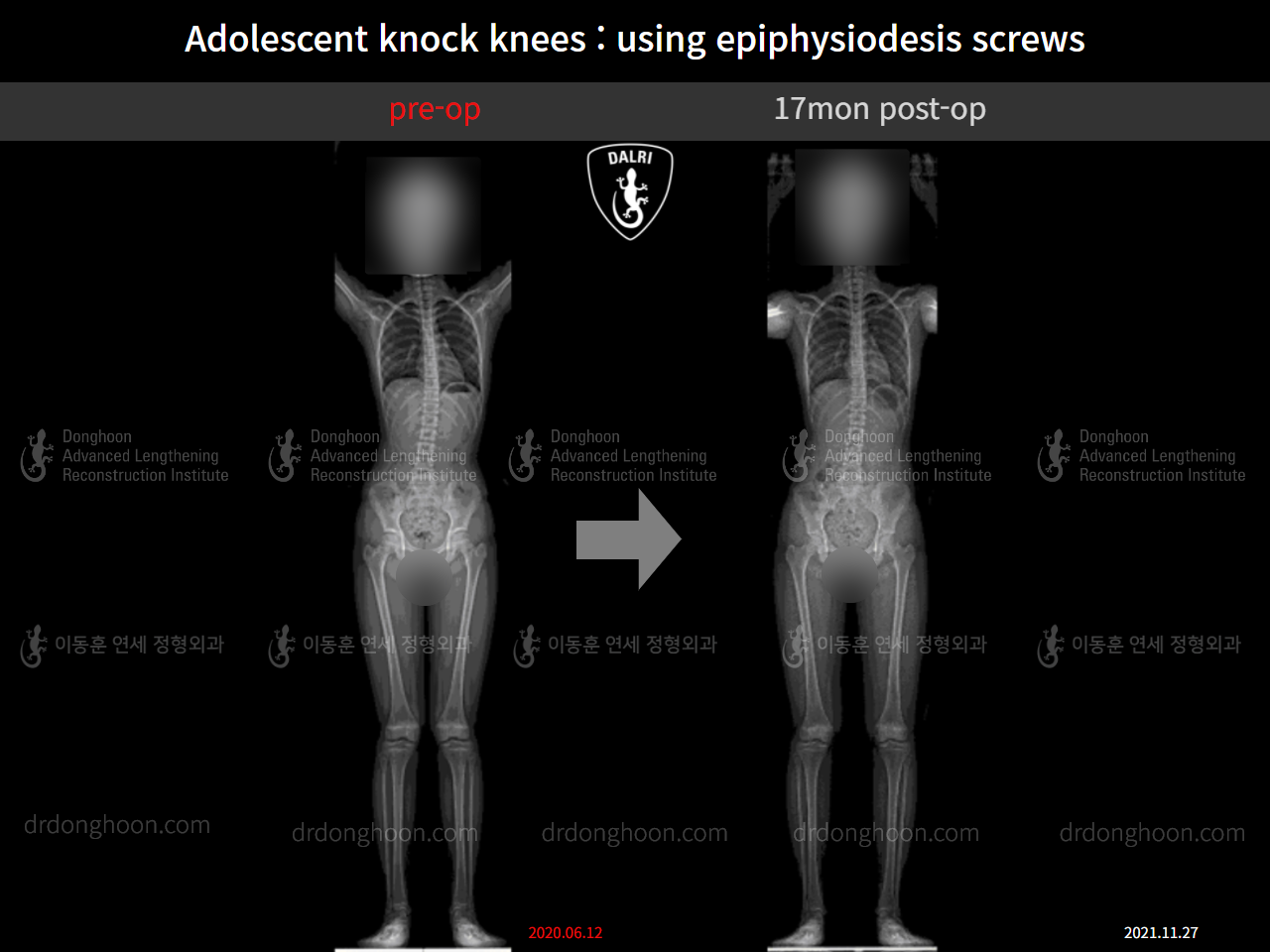 Before and after paediatric & adolescent knock knees, case 10451470, image 6, Dr. Donghoon institute (DALRI)