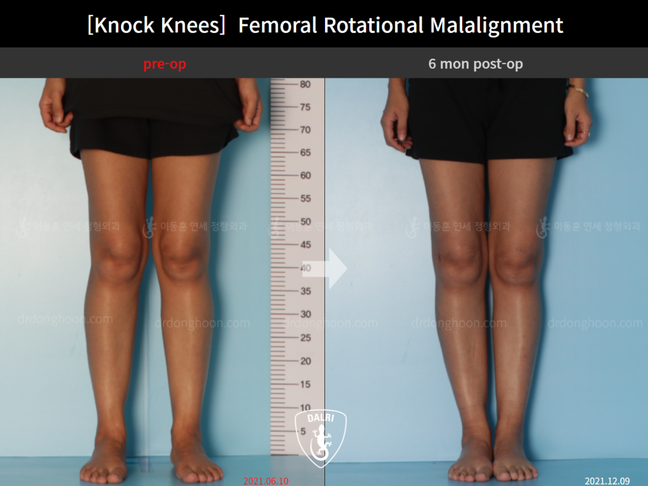 Before and after adult knock knees, case 9163067, image 3, Dr. Donghoon institute (DALRI)