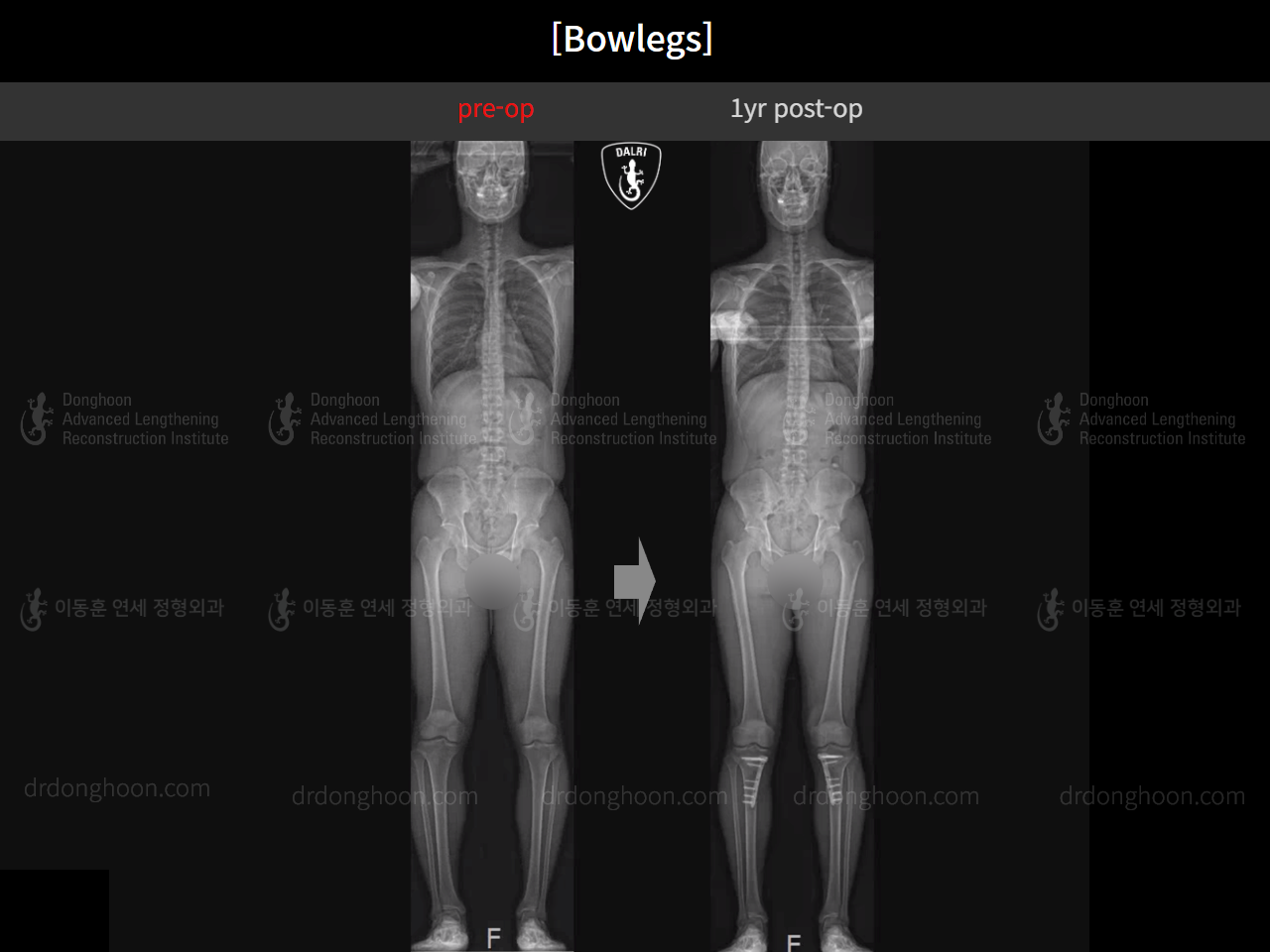Before and after adult bowlegs, case 16724494, image 12, Dr. Donghoon institute (DALRI)