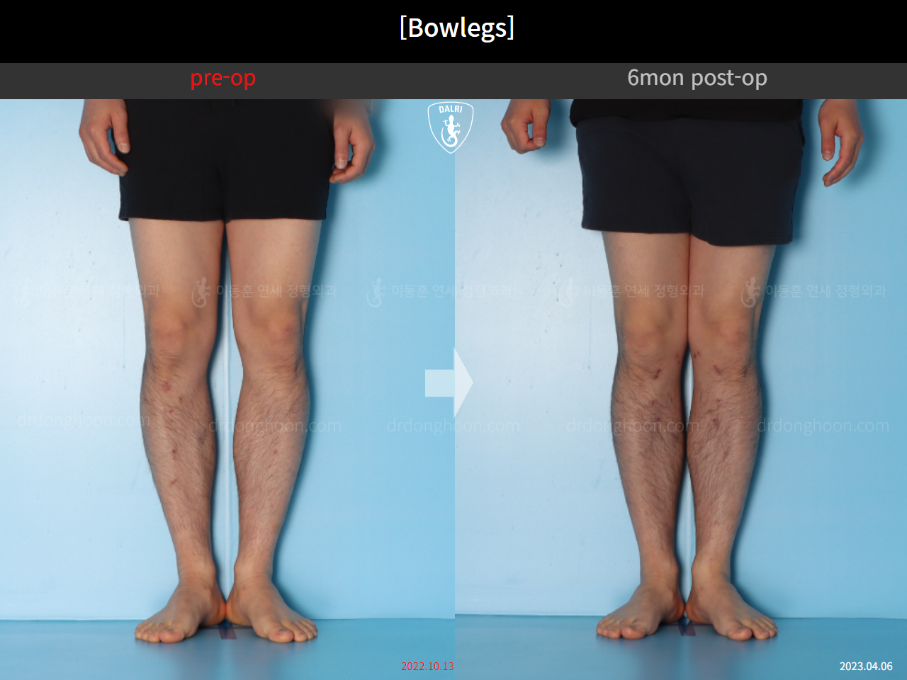 Before and after adult bowlegs, case 14742489, image 6, Dr. Donghoon institute (DALRI)