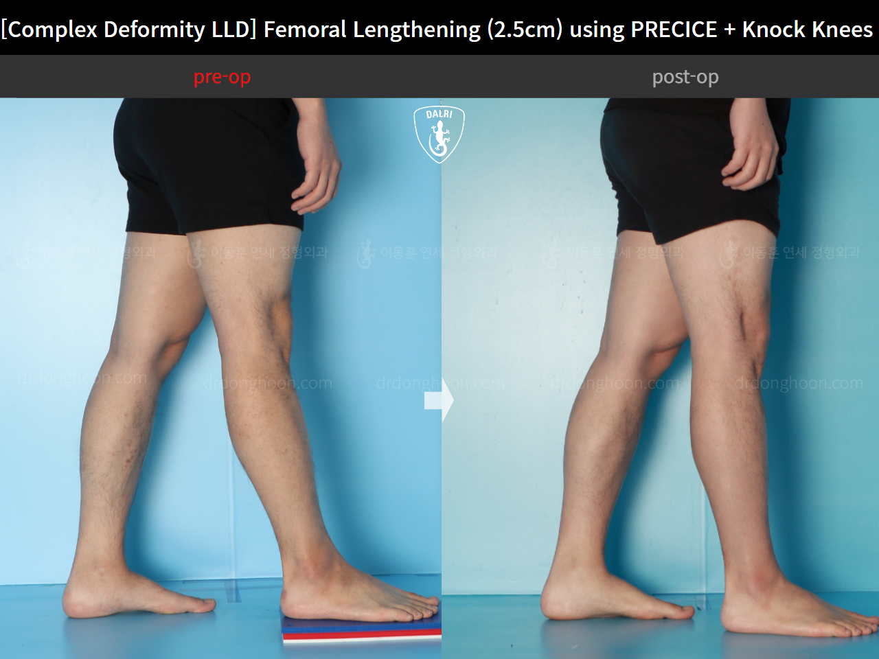 Before and after adult lld, case 17589131, image 7, Dr. Donghoon institute (DALRI)