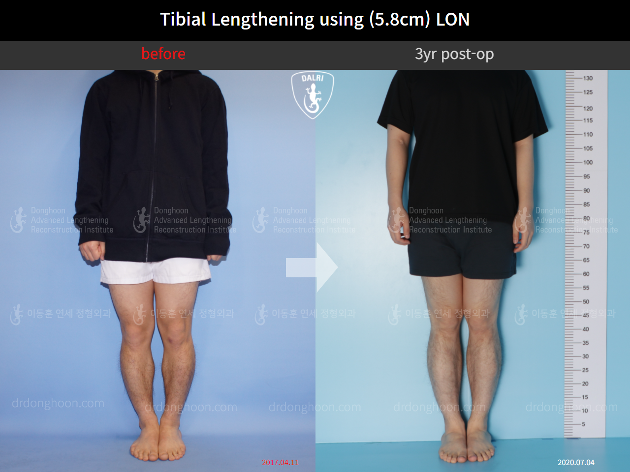 Before and after cll lon, case 10336887, image 1, Dr. Donghoon institute (DALRI)