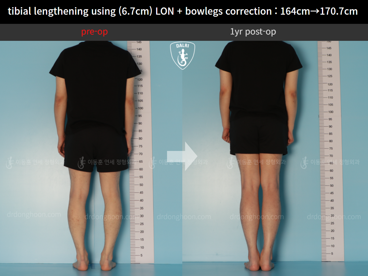 Before and after cll + deformity correction, case 11037343, image 2, Dr. Donghoon institute (DALRI)