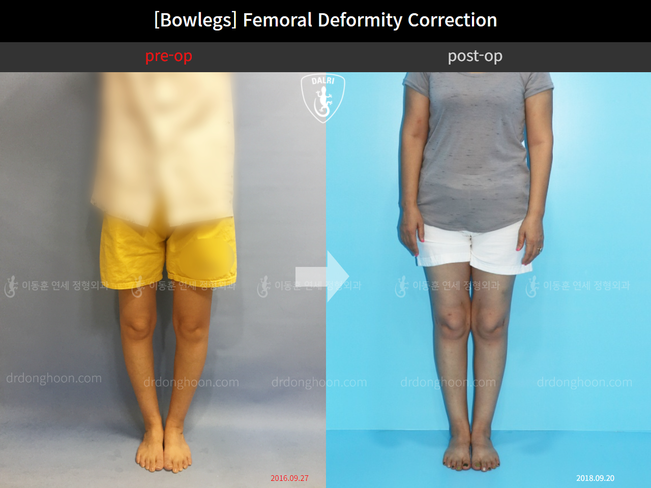 Before and after adult bowlegs, case 11379035, image 2, Dr. Donghoon institute (DALRI)