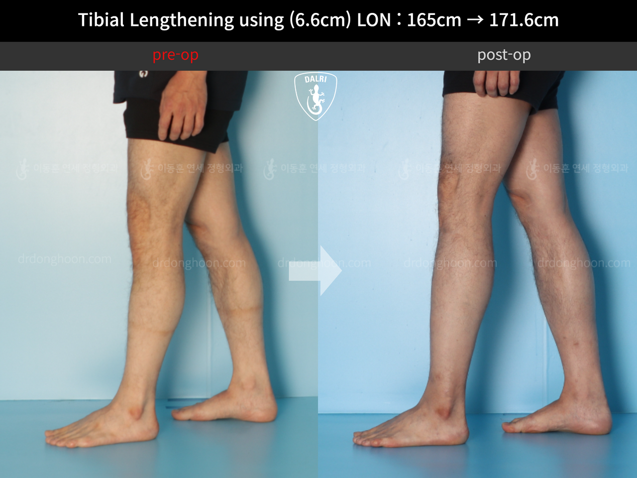 Before and after cll lon, case 12679338, image 8, Dr. Donghoon institute (DALRI)