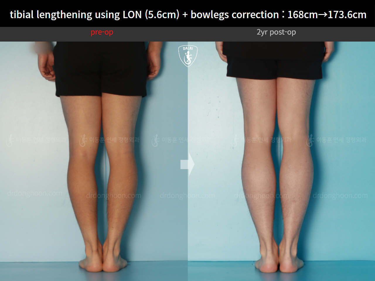 Before and after cll + deformity correction, case 17361975, image 6, Dr. Donghoon institute (DALRI)