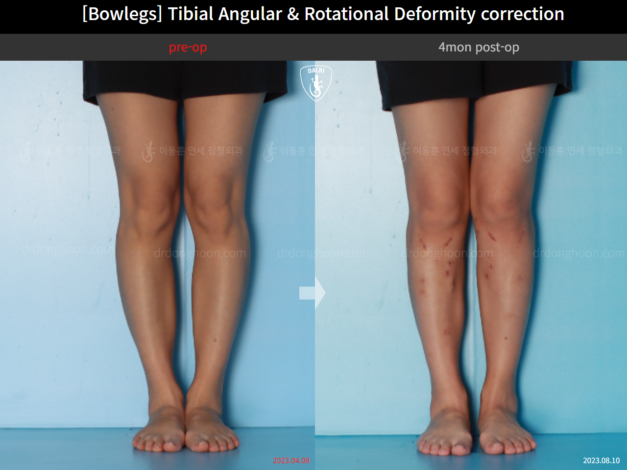 Before and after adult bowlegs, case 16530390, image 6, Dr. Donghoon institute (DALRI)