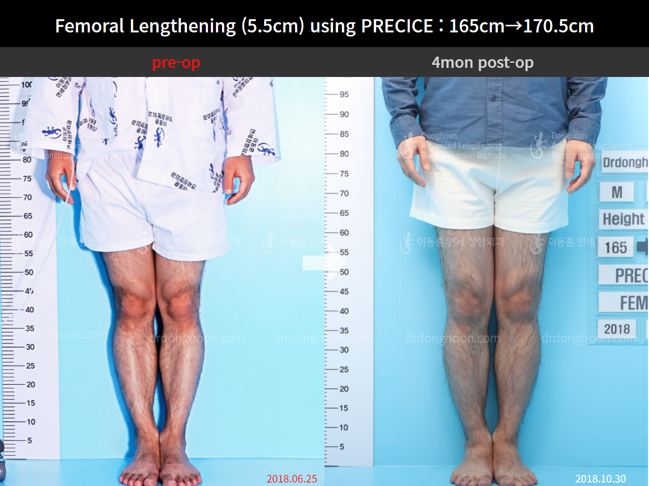 Before and after cll precice, case 4323379, image 3, Dr. Donghoon institute (DALRI)