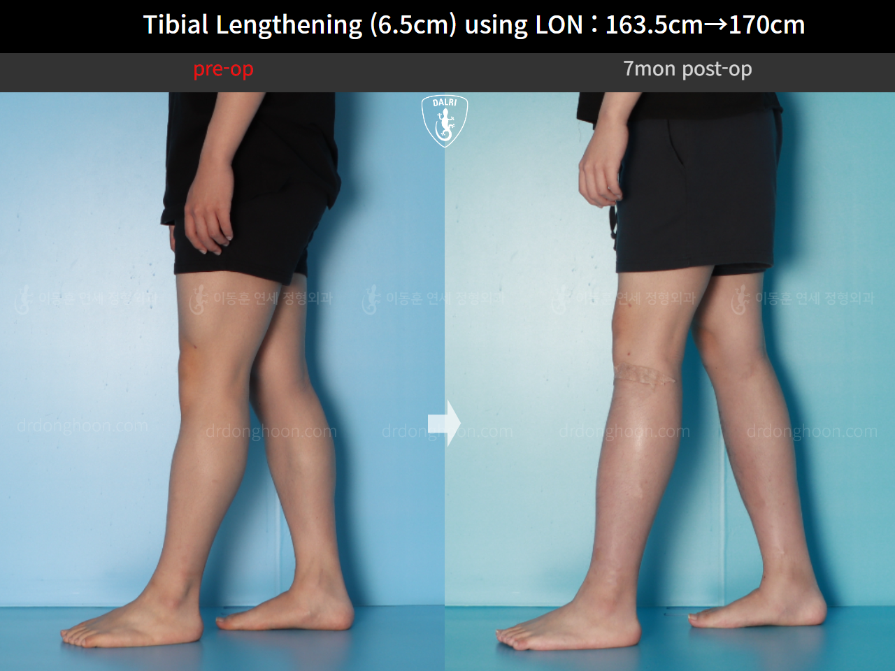 Before and after cll lon, case 17199046, image 7, Dr. Donghoon institute (DALRI)