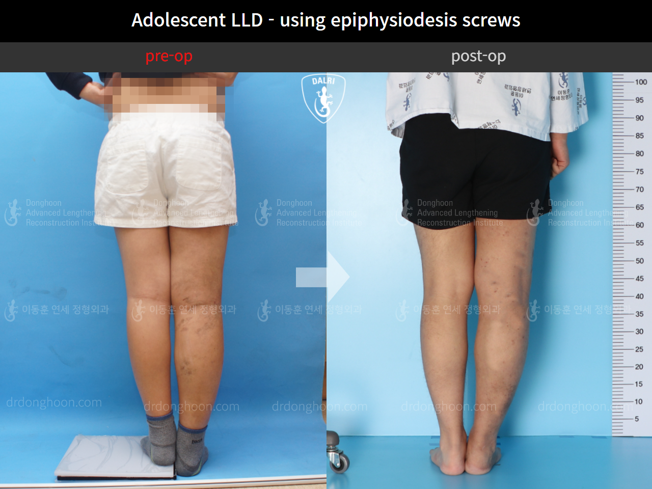 Before and after paediatric & adolescent lld, case 10452092, image 2, Dr. Donghoon institute (DALRI)