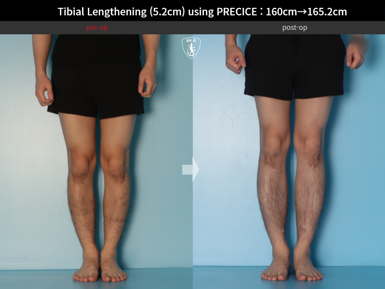 Before and after cll precice, case 27370351, image 5, Dr. Donghoon institute (DALRI)
