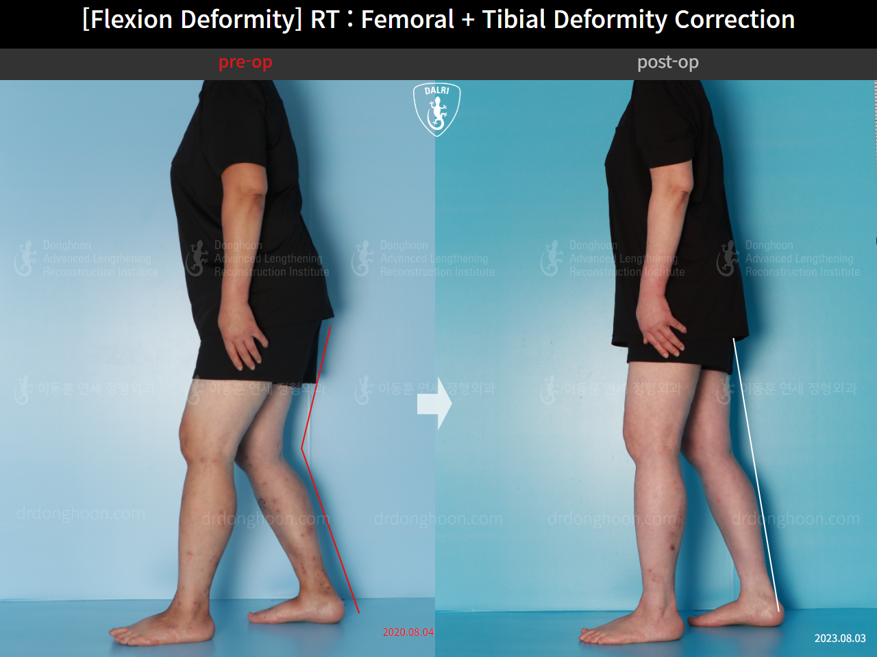 Before and after flexion deformity, case 15993081, image 3, Dr. Donghoon institute (DALRI)