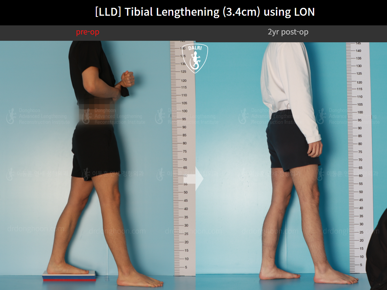 Before and after adult lld, case 17538143, image 3, Dr. Donghoon institute (DALRI)
