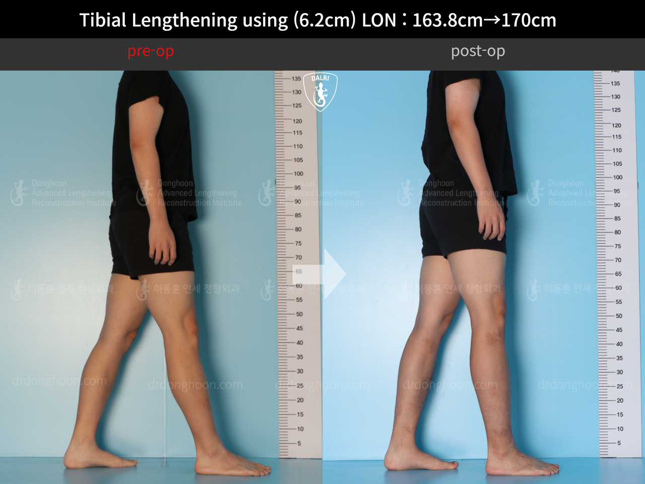 Before and after cll lon, case 13001983, image 4, Dr. Donghoon institute (DALRI)