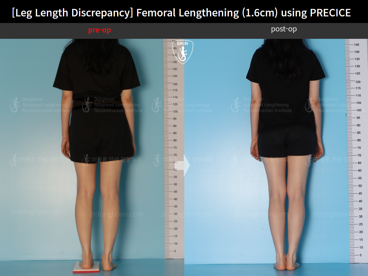 Before and after adult lld, case 15705968, image 2, Dr. Donghoon institute (DALRI)