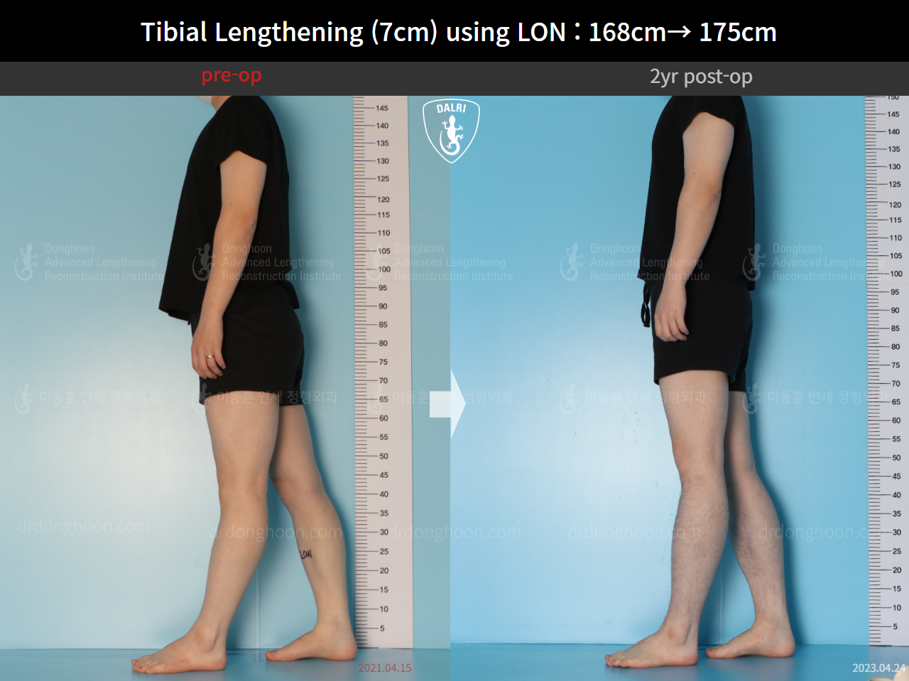 Before and after cll lon, case 14978046, image 3, Dr. Donghoon institute (DALRI)