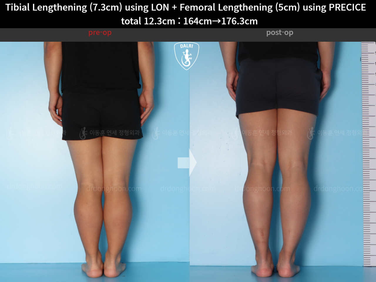 Before and after cll lon, case 15592729, image 6, Dr. Donghoon institute (DALRI)