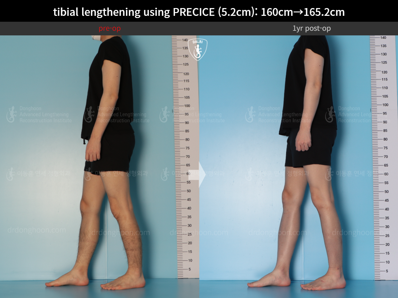 Before and after cll precice, case 15213098, image 7, Dr. Donghoon institute (DALRI)