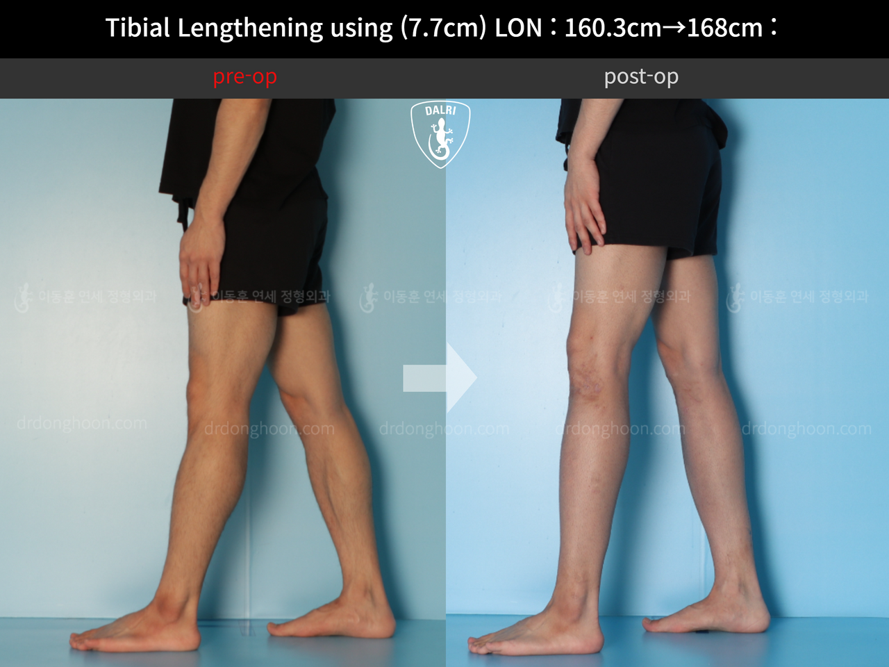 Before and after cll lon, case 12643440, image 8, Dr. Donghoon institute (DALRI)