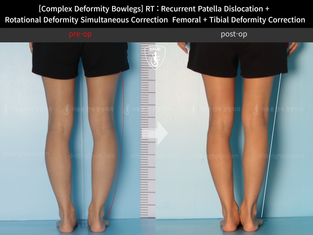 Before and after complex deformity, case 12255273, image 5, Dr. Donghoon institute (DALRI)