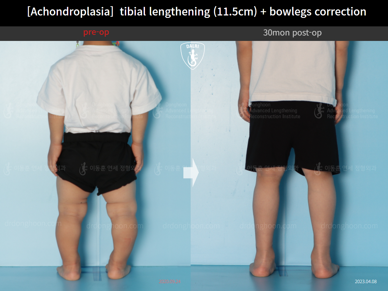 Before and after paediatric congenital condition, case 14957539, image 3, Dr. Donghoon institute (DALRI)