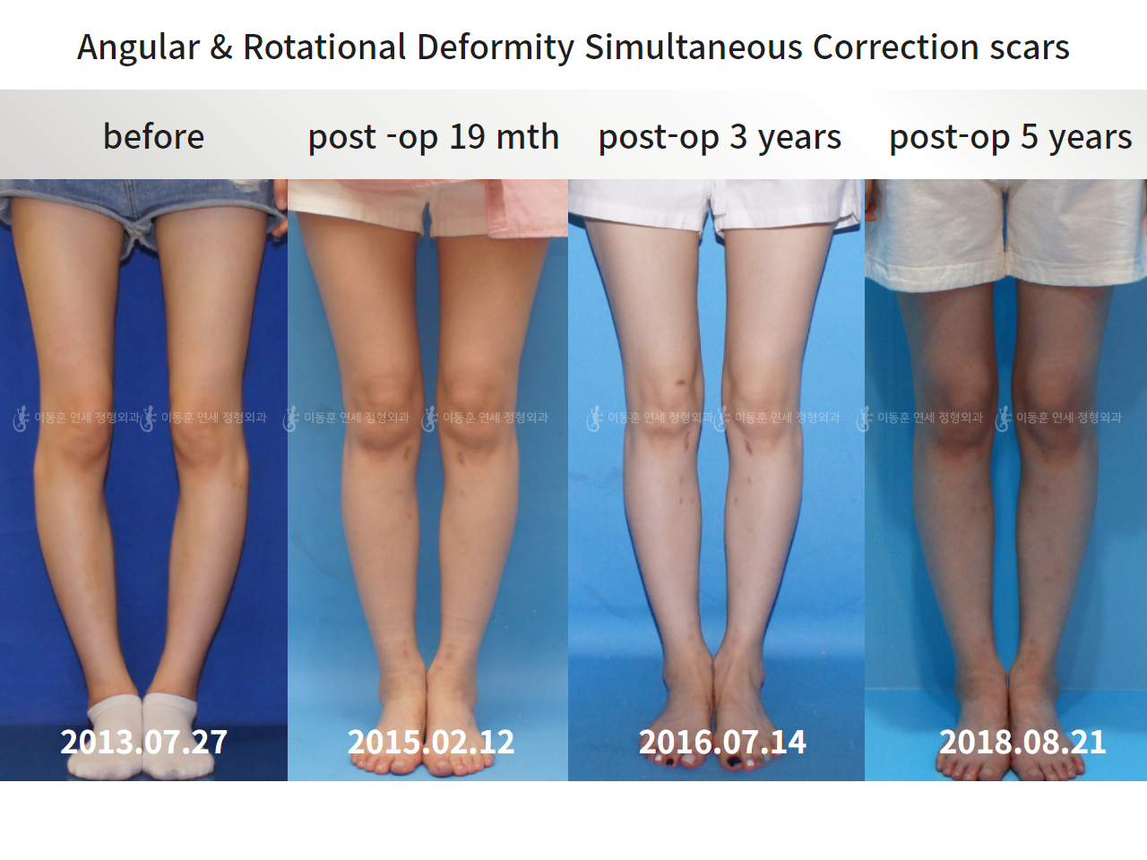 Before and after adult bowlegs, case 5983566, image 1, Dr. Donghoon institute (DALRI)