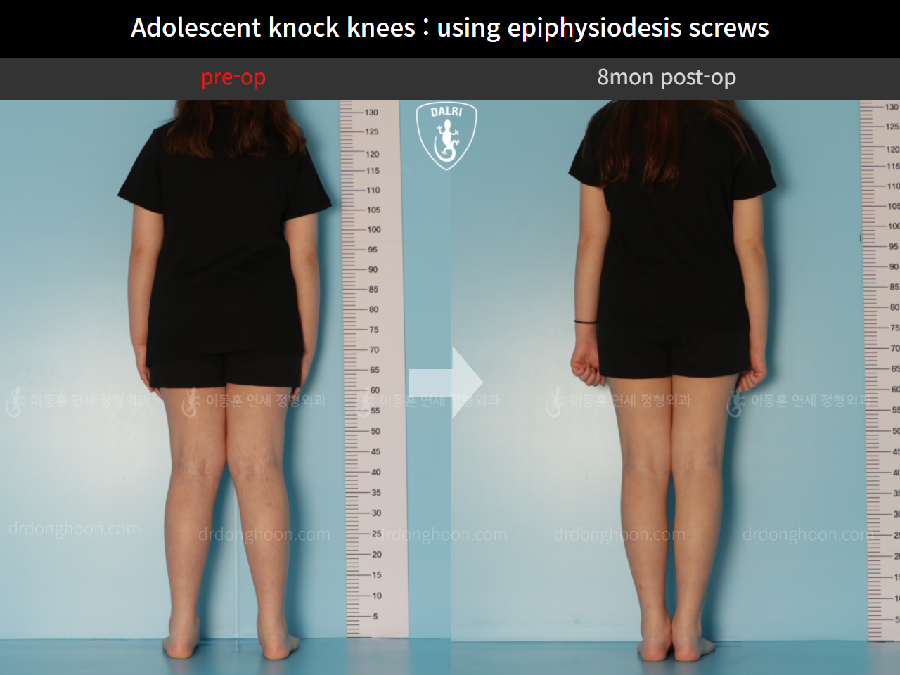 Before and after paediatric & adolescent knock knees, case 10297056, image 2, Dr. Donghoon institute (DALRI)