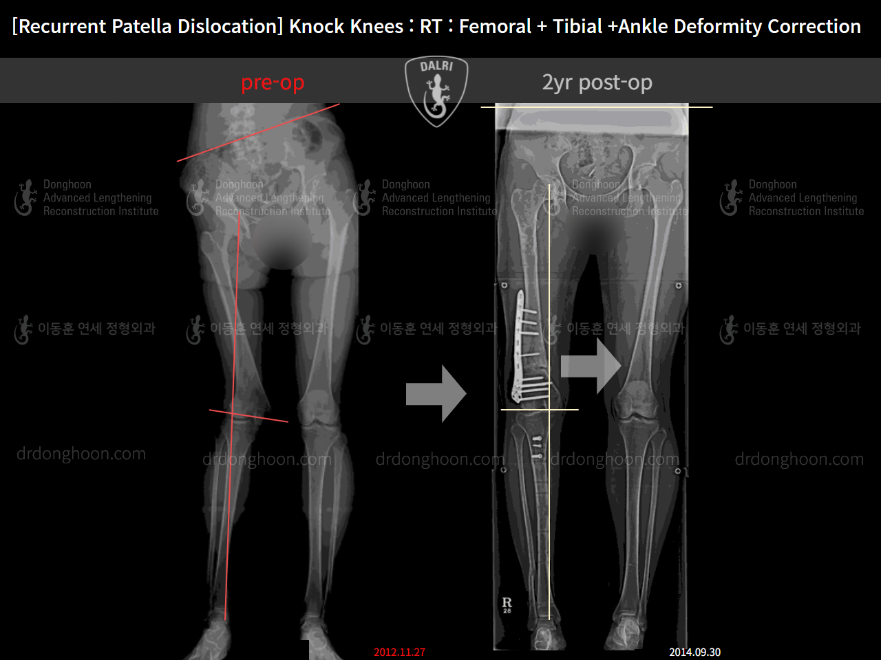 Before and after recurrent patella dislocation, case 10780562, image 3, Dr. Donghoon institute (DALRI)