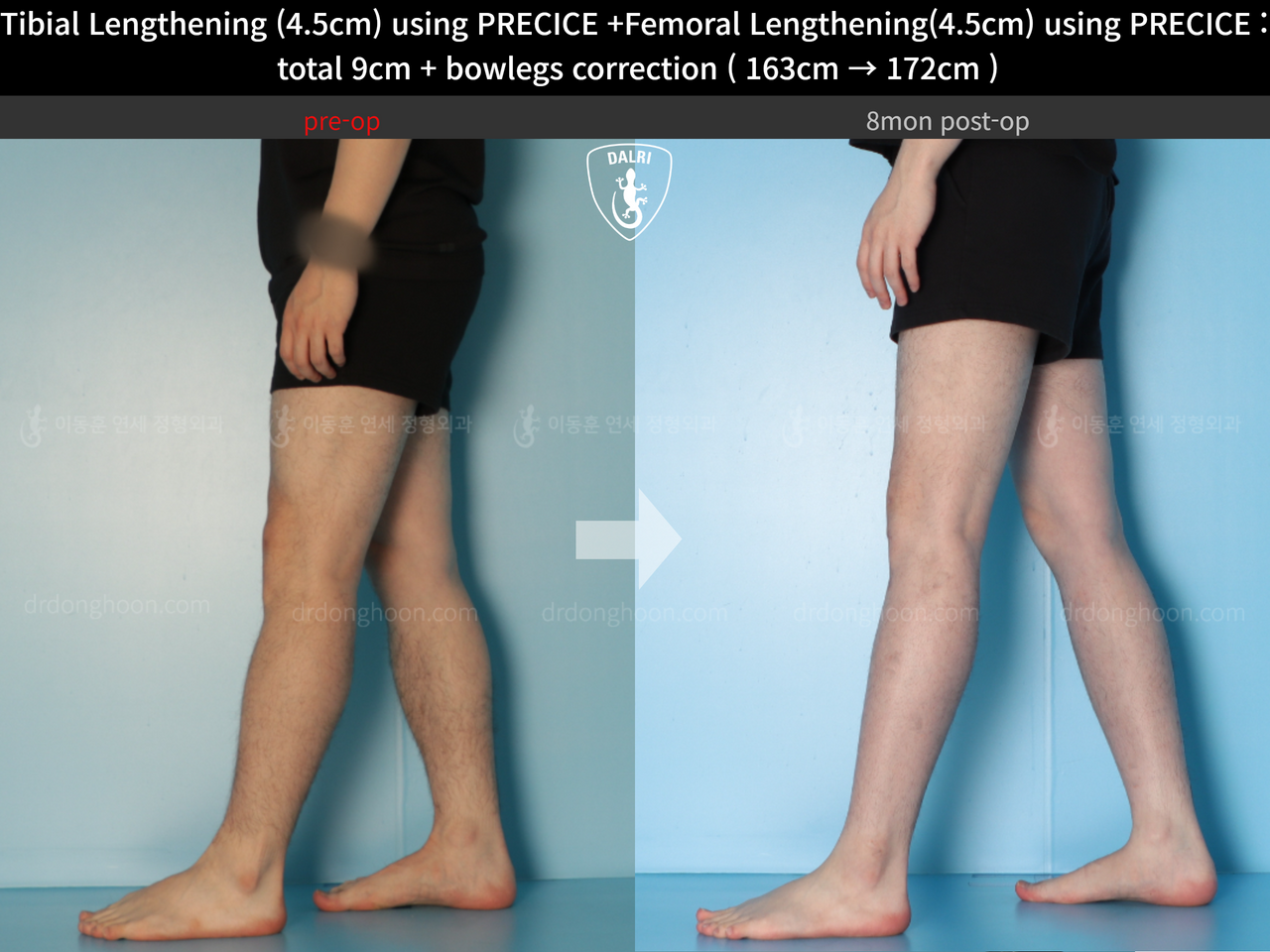Before and after cll precice, case 13912585, image 11, Dr. Donghoon institute (DALRI)